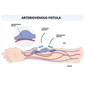 AV Fistula Creation