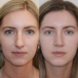 Blepharoplasty