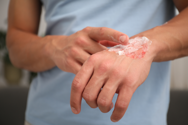 Burn Injuries & Contractures