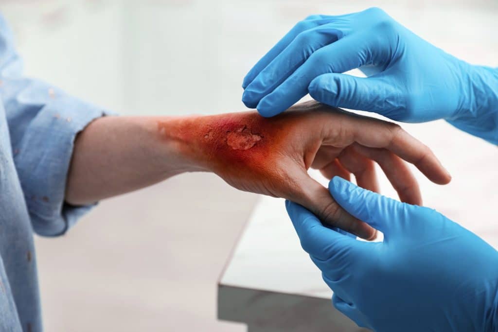 Burn injuries and contractures