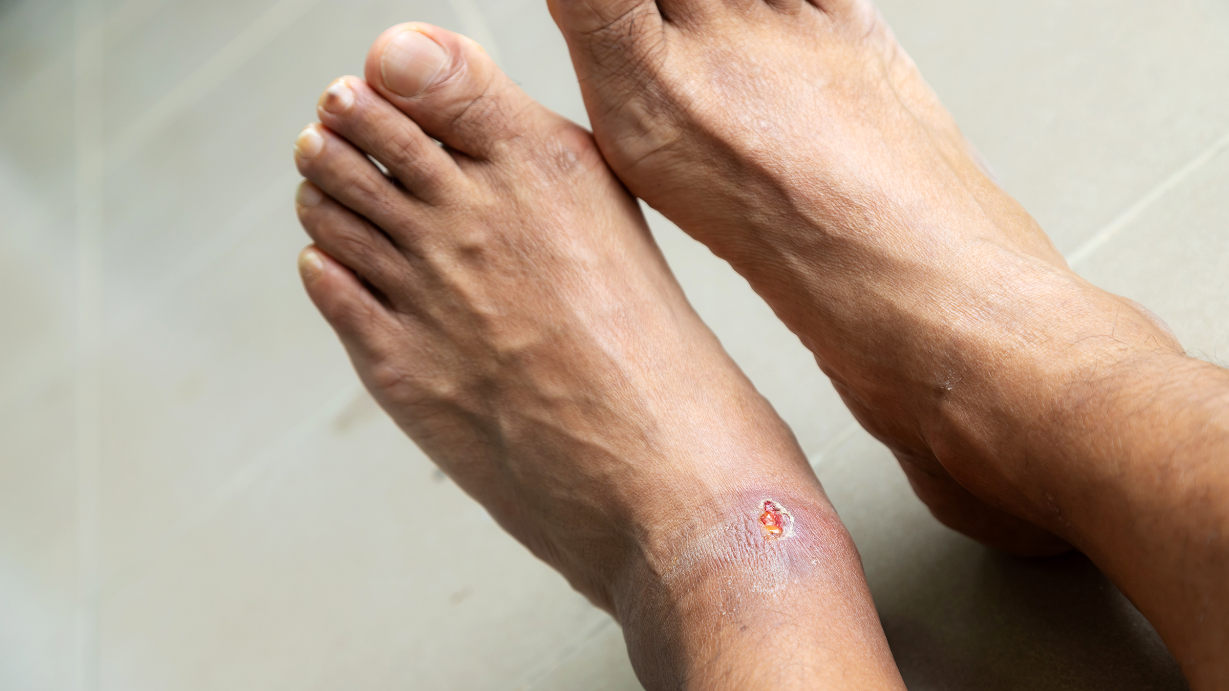 Diabetic Foot Treatment