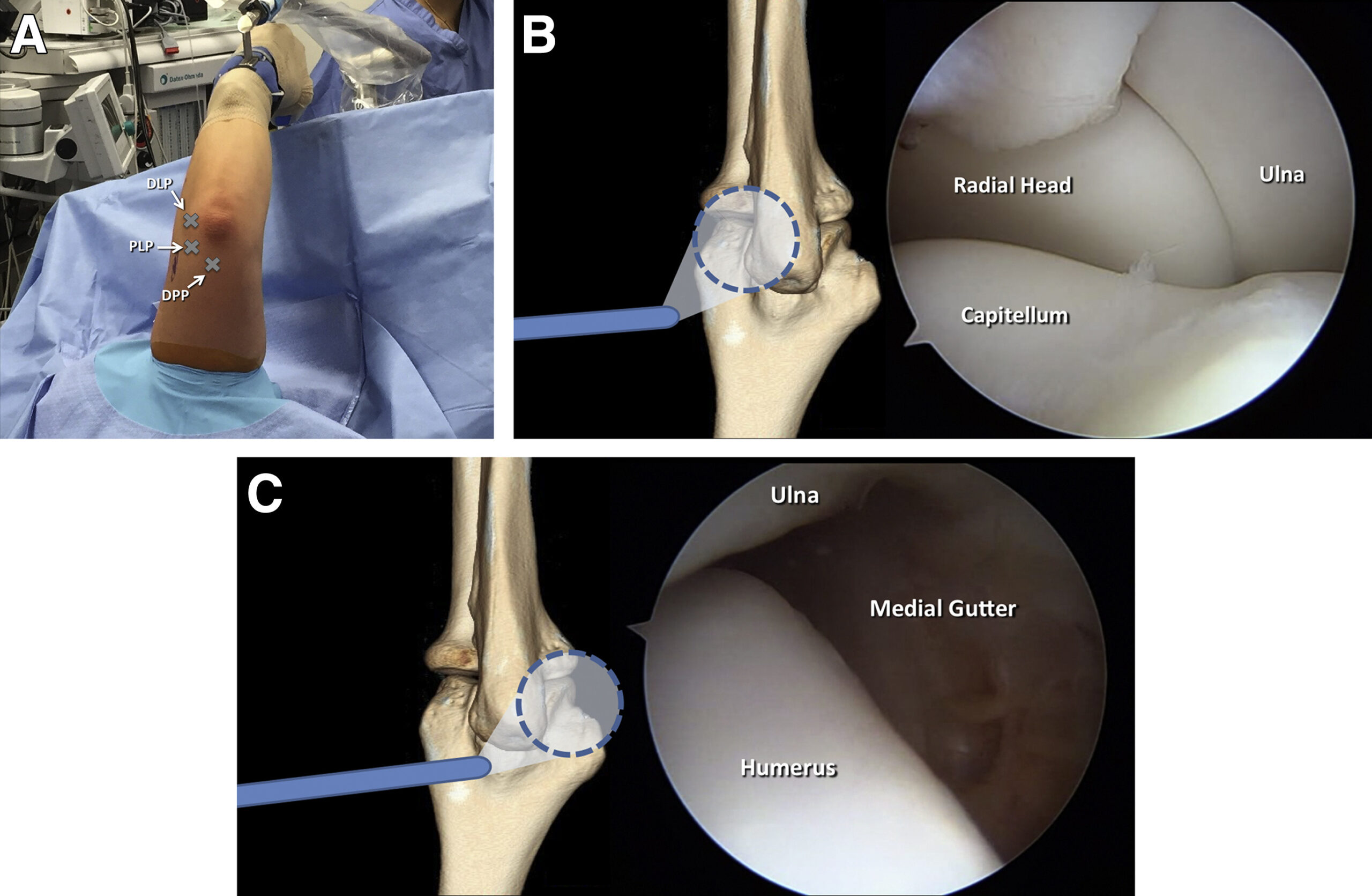 Elbow Arthroscopy