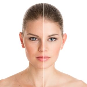 Facial rejuvenation