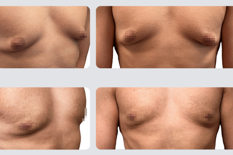 Gynaecomastia