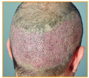 Hair transplant