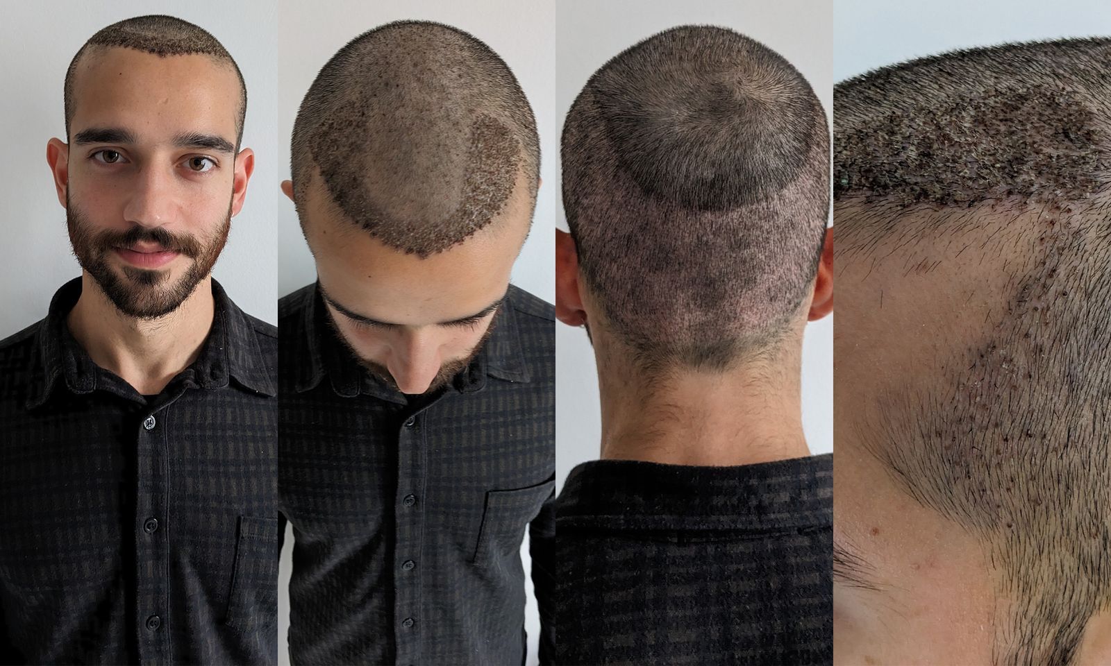 Hair transplant