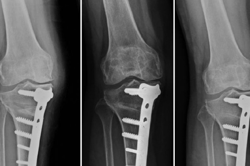 High Tibial Osteotomy (HTO)