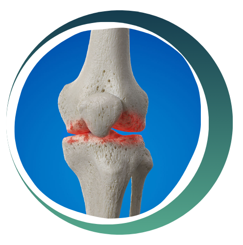High Tibial Osteotomy (HTO)