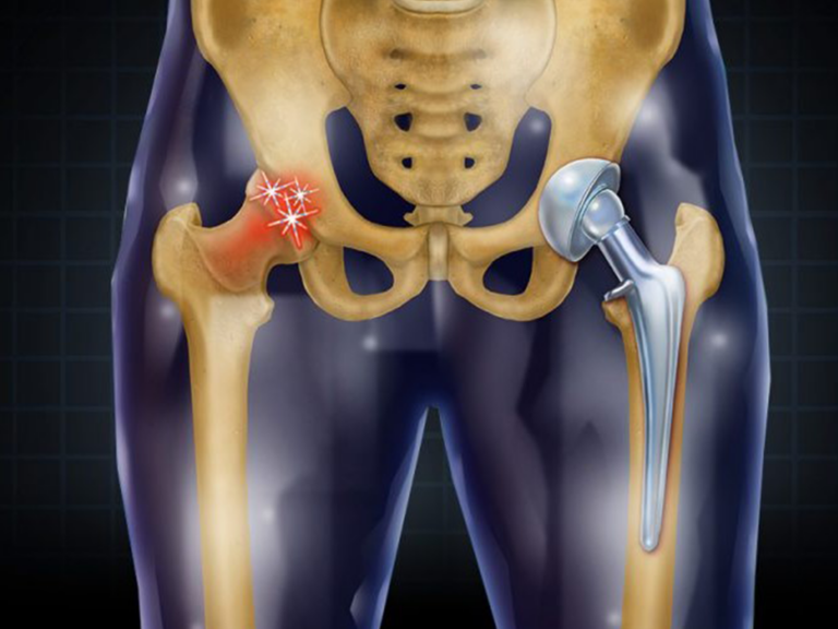 Hip Replacement Surgery | Asian Institute of Advanced Surgeries