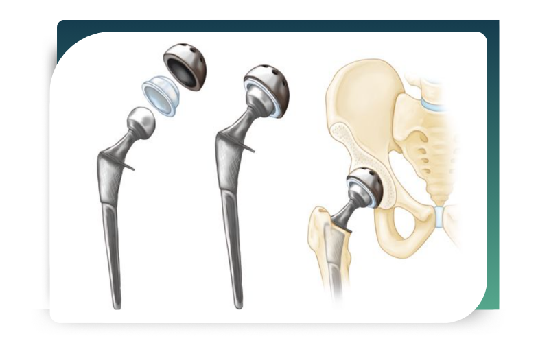 Hip Replacement Surgery
