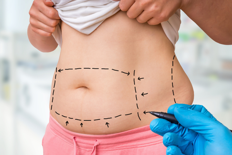 Liposuction