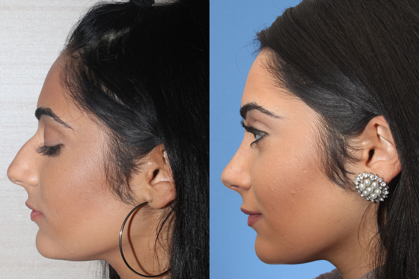 Rhinoplasty