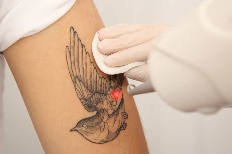 Tattoo Removal Treatment