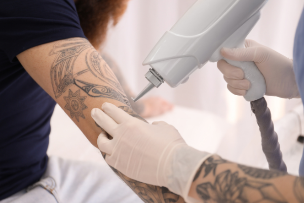 Tattoo removal treatment
