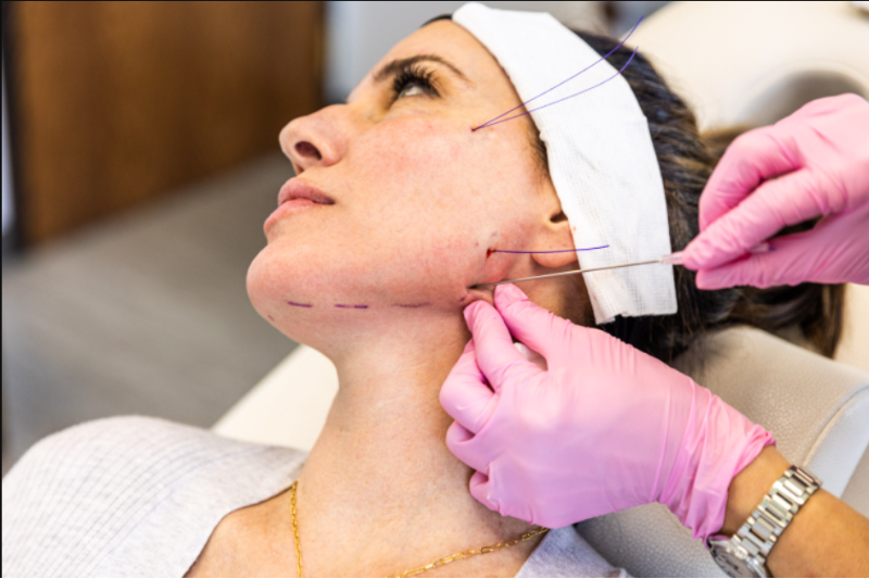 Thread Lift Treatment