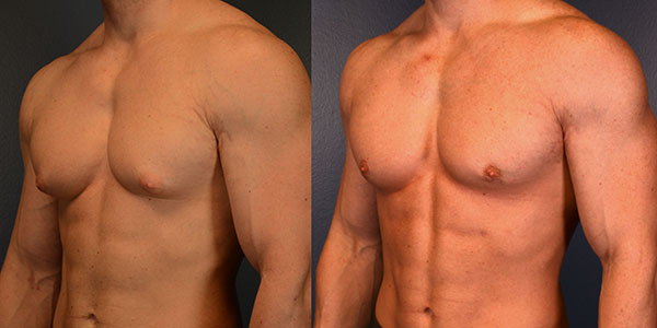Gynecomastia