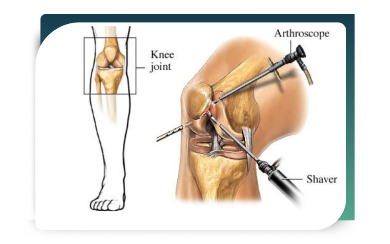 sports arthroscopy
