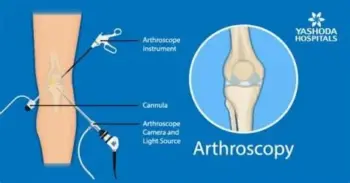 Arthroscopic injury solutions