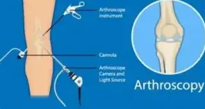 Arthroscopic injury solutions