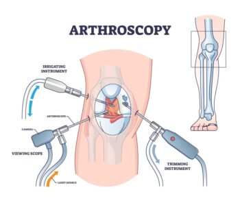 Arthroscopic joint repair