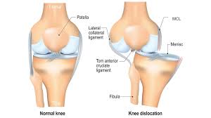 Best Knee Ligament Surgeon In Gondia