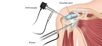 Best Shoulder Surgeon In Gondia