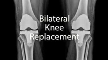 Bilateral knee replacement