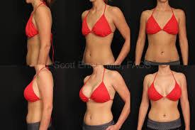 Breast Augmentation In Bhopal