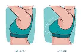 Breast Augmentation In Gwalior