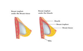 Breast Augmentation In Rewa