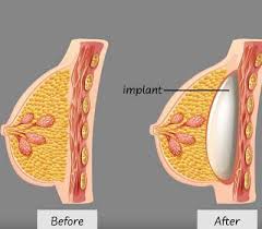 Breast Augmentation in Janjgir-Champa