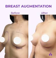 Breast Augmentation in Kanker