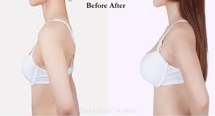 Breast Augmentation in Koriya