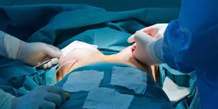 Breast Reconstruction Surgery in Nagpur