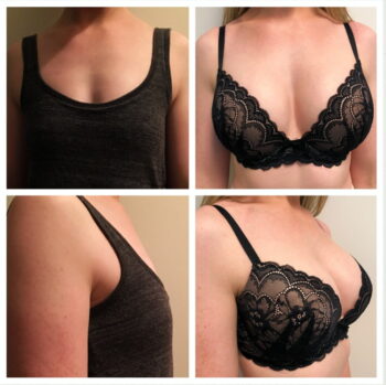 Breast augmentation in yavatmal