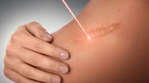 Burn Scar Correction in Nagpur