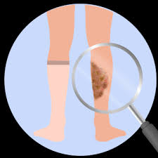 Chronic Wound Treatment in Nagpur