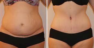 Cosmetic Body Reshaping in Nagpur
