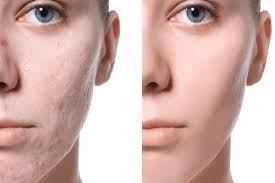 Cosmetic Scar Management in Nagpur