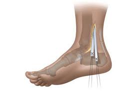 Foot Reconstruction Surgery in Nagpur