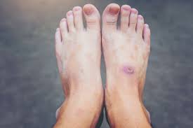 Foot Ulcer Management in Nagpur