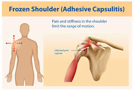 Frozen Shoulder Treatment in Nagpur