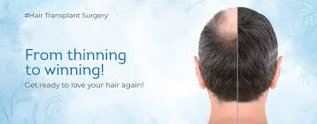 Hair Transplant in Nagpur