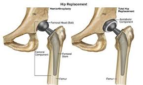 Hip Replacement Surgery In Bhind