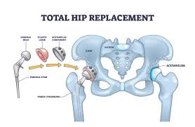 Hip Replacement Surgery In Guna