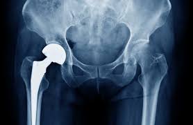 Hip Replacement Surgery In Shivpuri