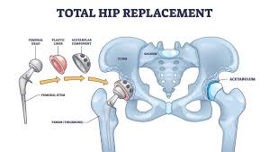 Hip Replacement Surgery in Balod