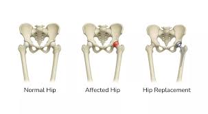 Hip Replacement Surgery in Bastar