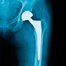Hip Replacement Surgery in Dantewada