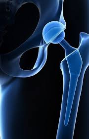 Hip Replacement Surgery in Janjgir-Champa